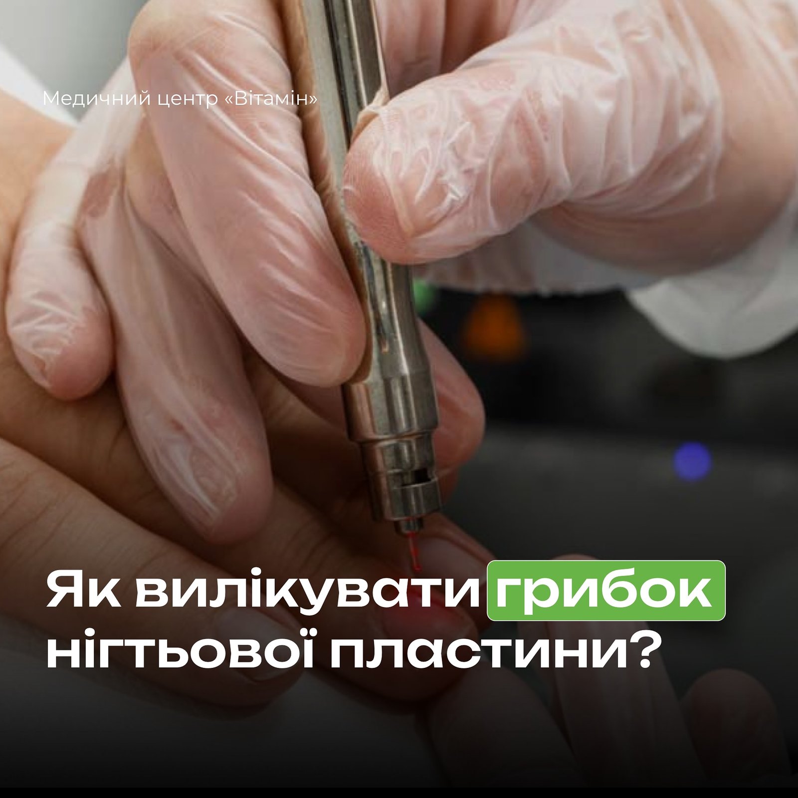 Грибок нігтів – доволі поширена проблема, що починається з білих або жовтих плям зовнішнього краю чи цілого нігтя. У міру прогресування грибкової інфекції нігті можуть знебарвитися, потовщуватись, злущуватися та розшаровуватися. - Медичний центр Вітамін