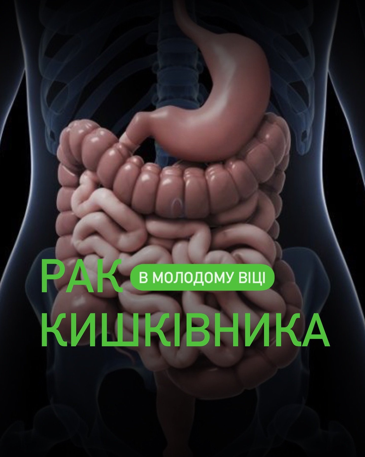 Рак кишківника (колоректальний рак) у молодому віці: важлива інформація - Медичний центр Вітамін