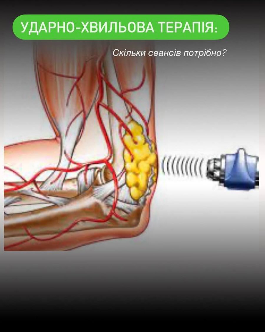 Ударно-хвильова терапія: Скільки сеансів потрібно? - Медичний центр Вітамін