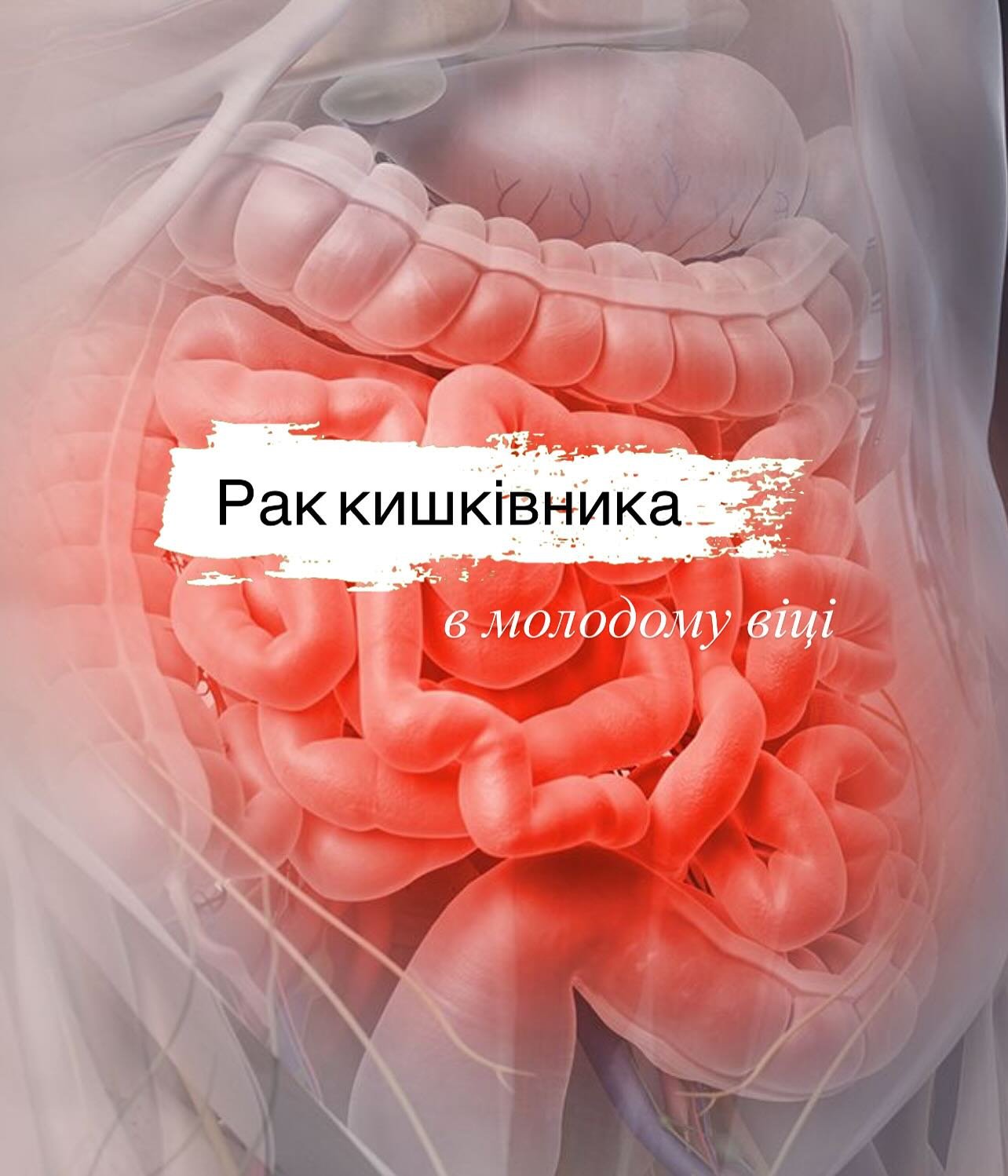 568765346_18081000911022844_7801109169469460938_n Рак кишківника (колоректальний рак) у молодому віці: важлива інформація - Медичний центр Вітамін