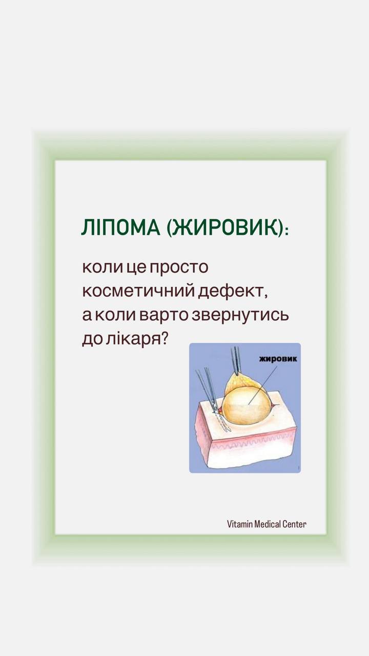 «Це просто жировик…»Саме так часто кажуть люди, коли помічають під шкірою невелике ущільнення. - Медичний центр Вітамін